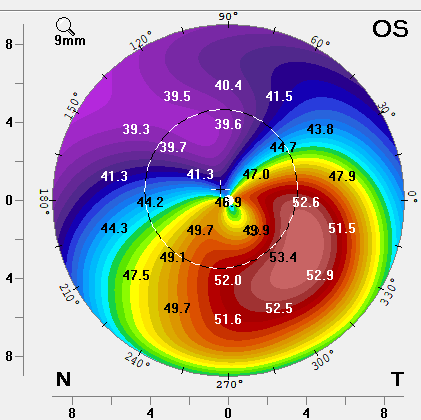 Topografía corneal de un paciente con queratocono