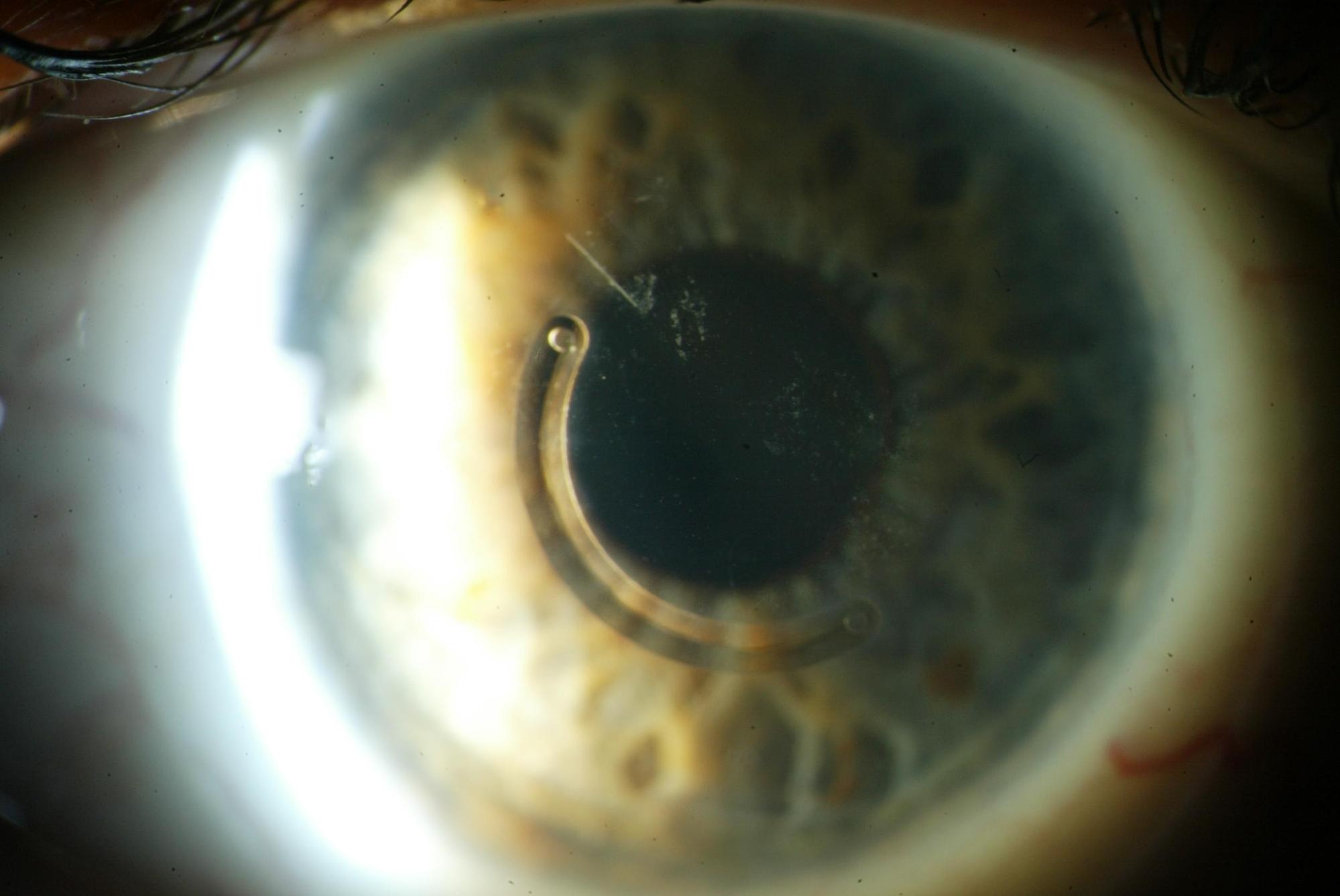 Anillos intracorneales para el tratamiento del queratocono