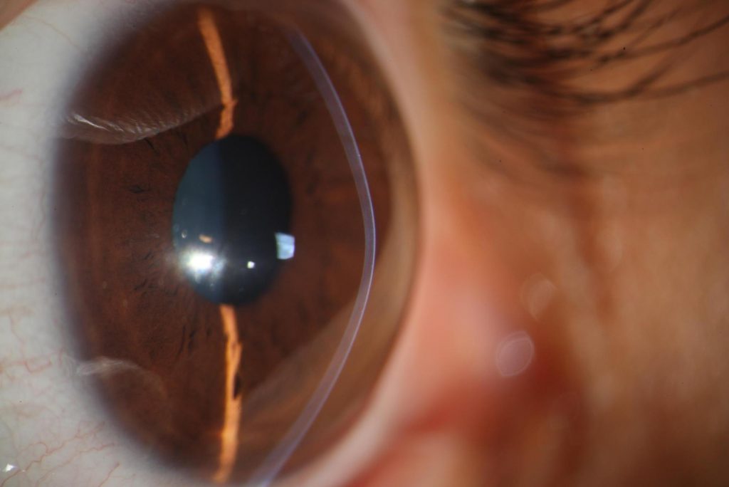 cirugía de córnea por Queratocono