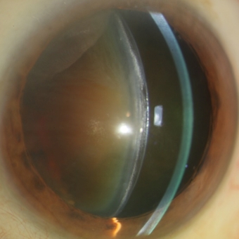 Catarata nuclear avanzada