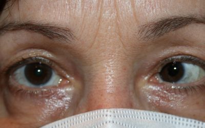 EARLY DETECTION IS THE KEY TO TREATING CHILDHOOD STRABISMUS