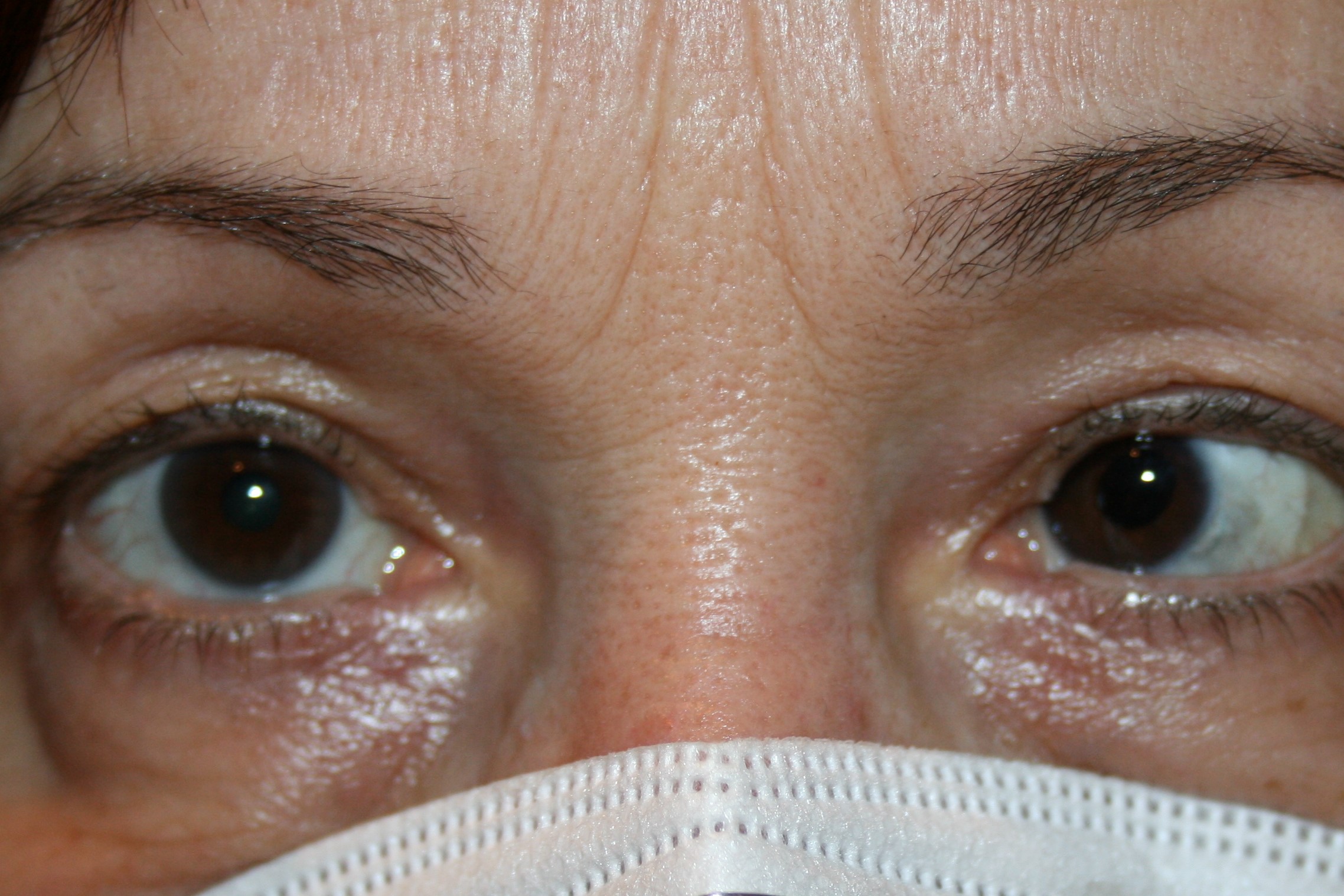 La detección precoz es clave en el estrabismo infantil