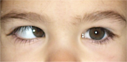 corregir el estrabismo niños adultos barcelona