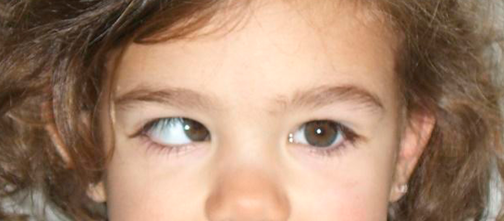 Estrabismo convergente en una niña
