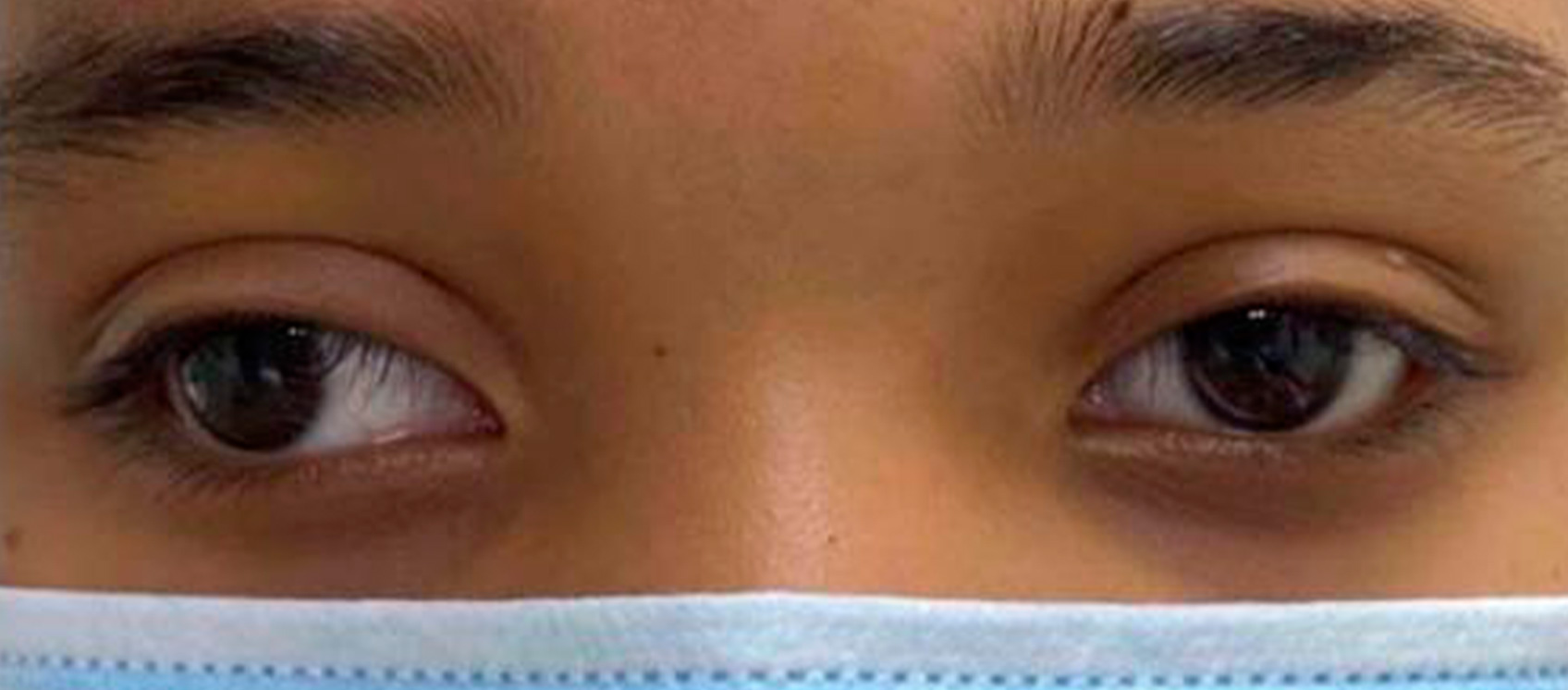 Estrabismo divergente