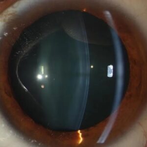 Cristalino transparente.