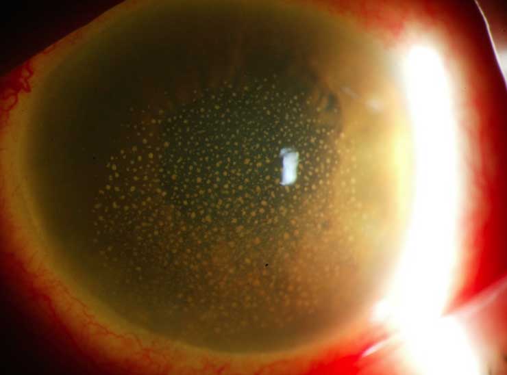 inflamaciones oculares asociadas a la úvea