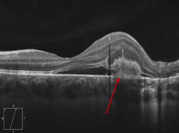 OCT de un paciente con DMAE en la que se aprecia una membrana neovascular.