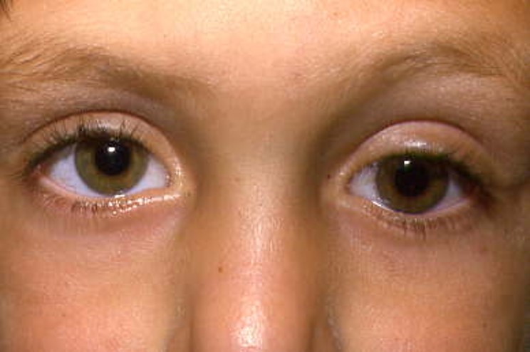 Estrabismo en niños y adultos. Correción y tratamientos