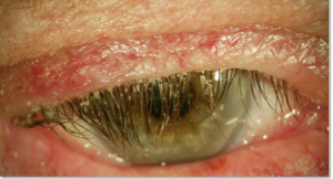 ojo seco blefaritis tratamiento barcelona