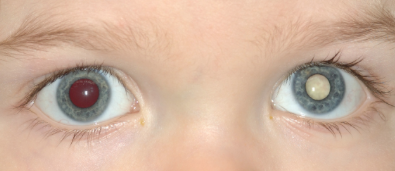 Paciente con una ambliopía del ojo izquierdo causada por una catarata blanca.