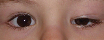 Paciente con una ambliopía del ojo izquierdo causada por ptosis palpebral