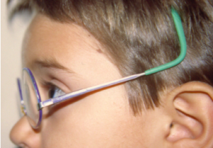 montura mal adaptada gafas para niños