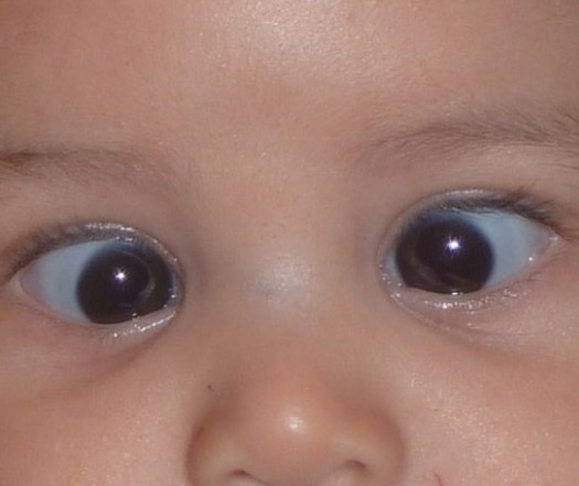 ¿Qué es la endotropia acomodativa y cómo se puede solucionar?