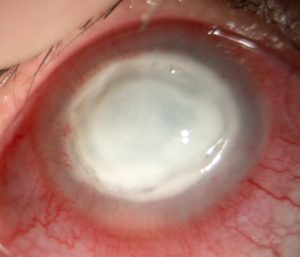 lentillas de contacto infección