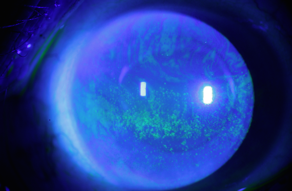 Paciente con ojo seco que presenta queratitis punteada superficial 