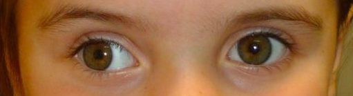 estrabismo toxina botulínica como tratamiento de la desviación en ojos oftalmologo estrabismo