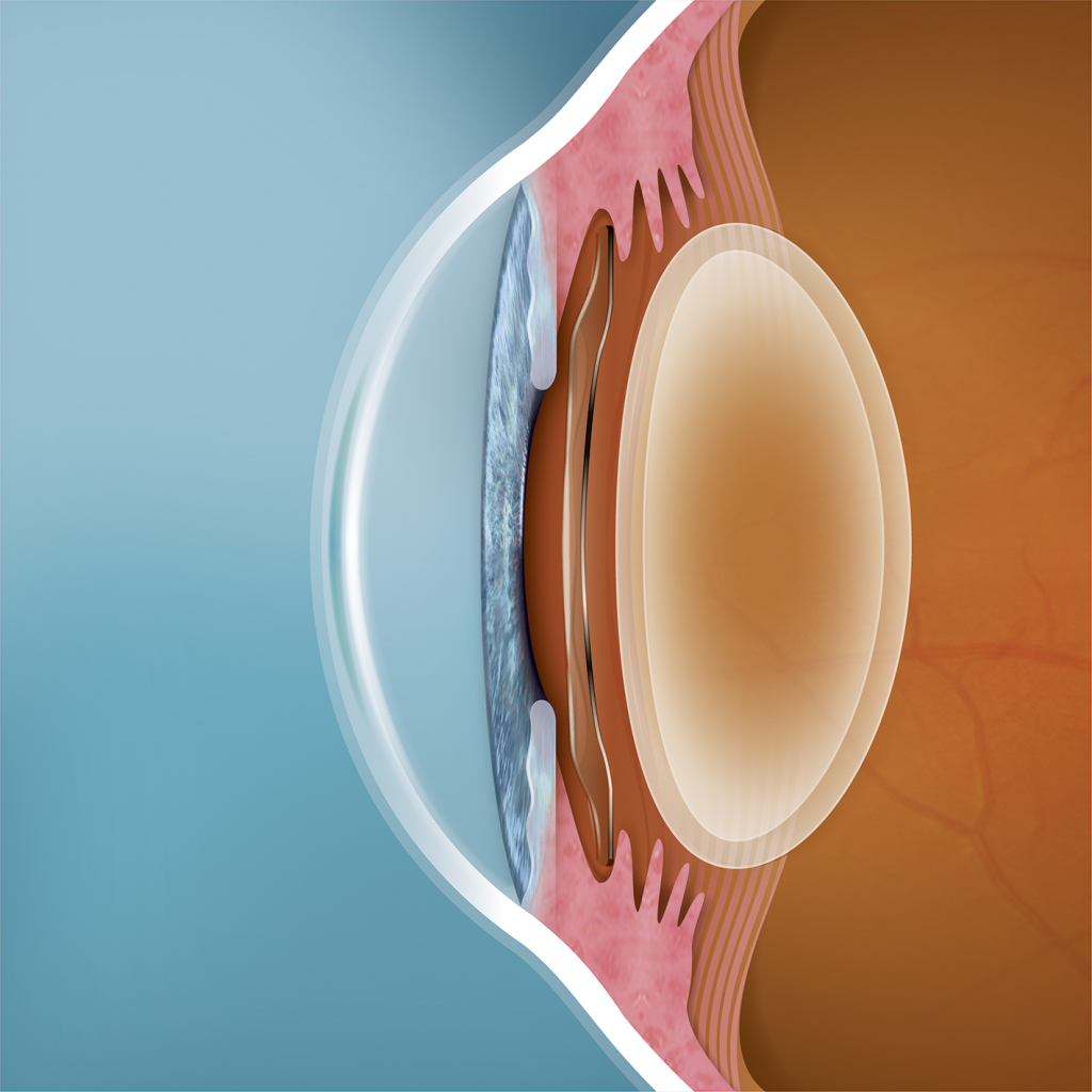 ICL intraocular
