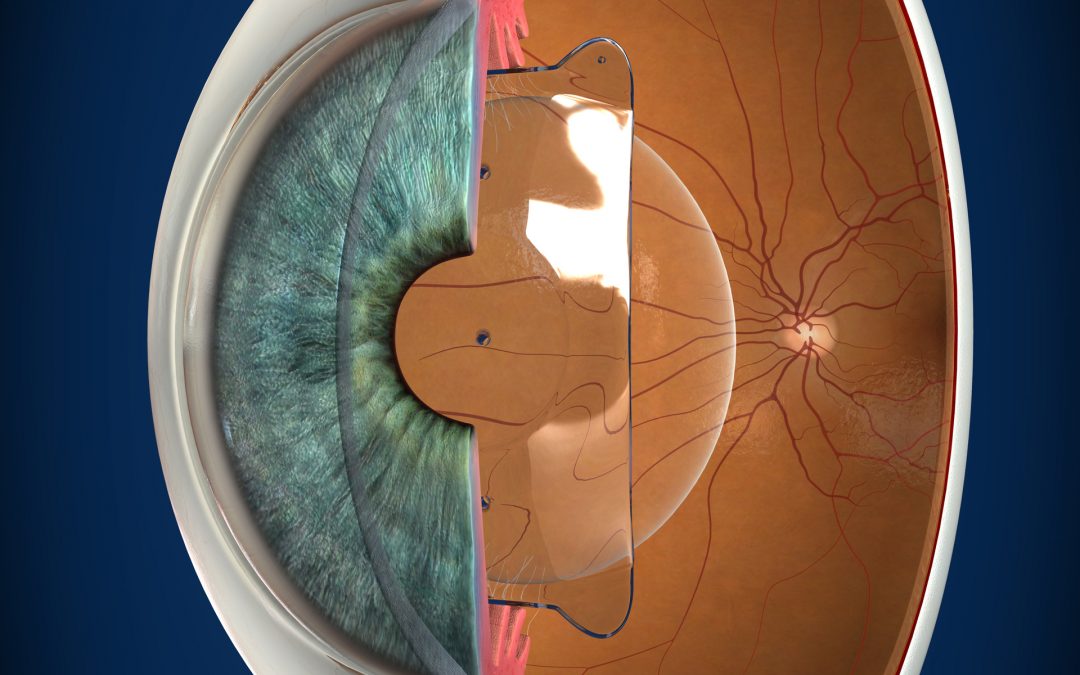 ICL implantada en el ojo