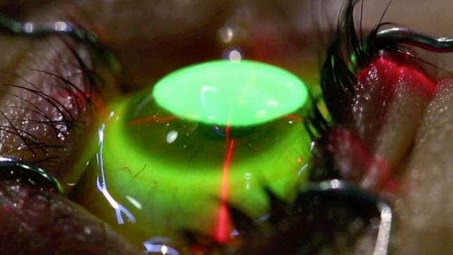 Luz UVA sobre la córnea