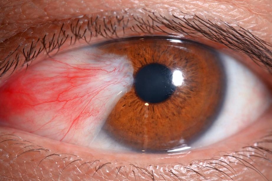 Paciente con pterigion de gran tamaño