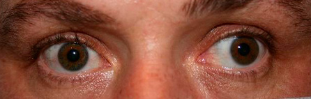 Paciente con un estrabismo divergente