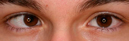 Paciente con un estrabismo convergente