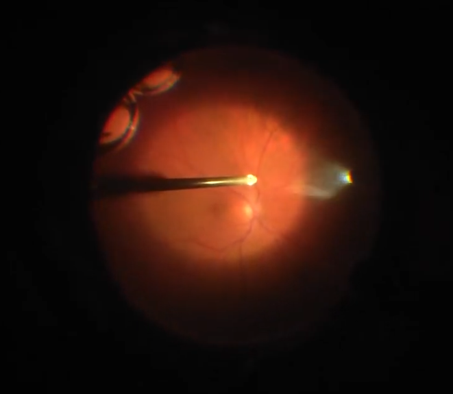 Imagen de un ojo operado de vitrectomia