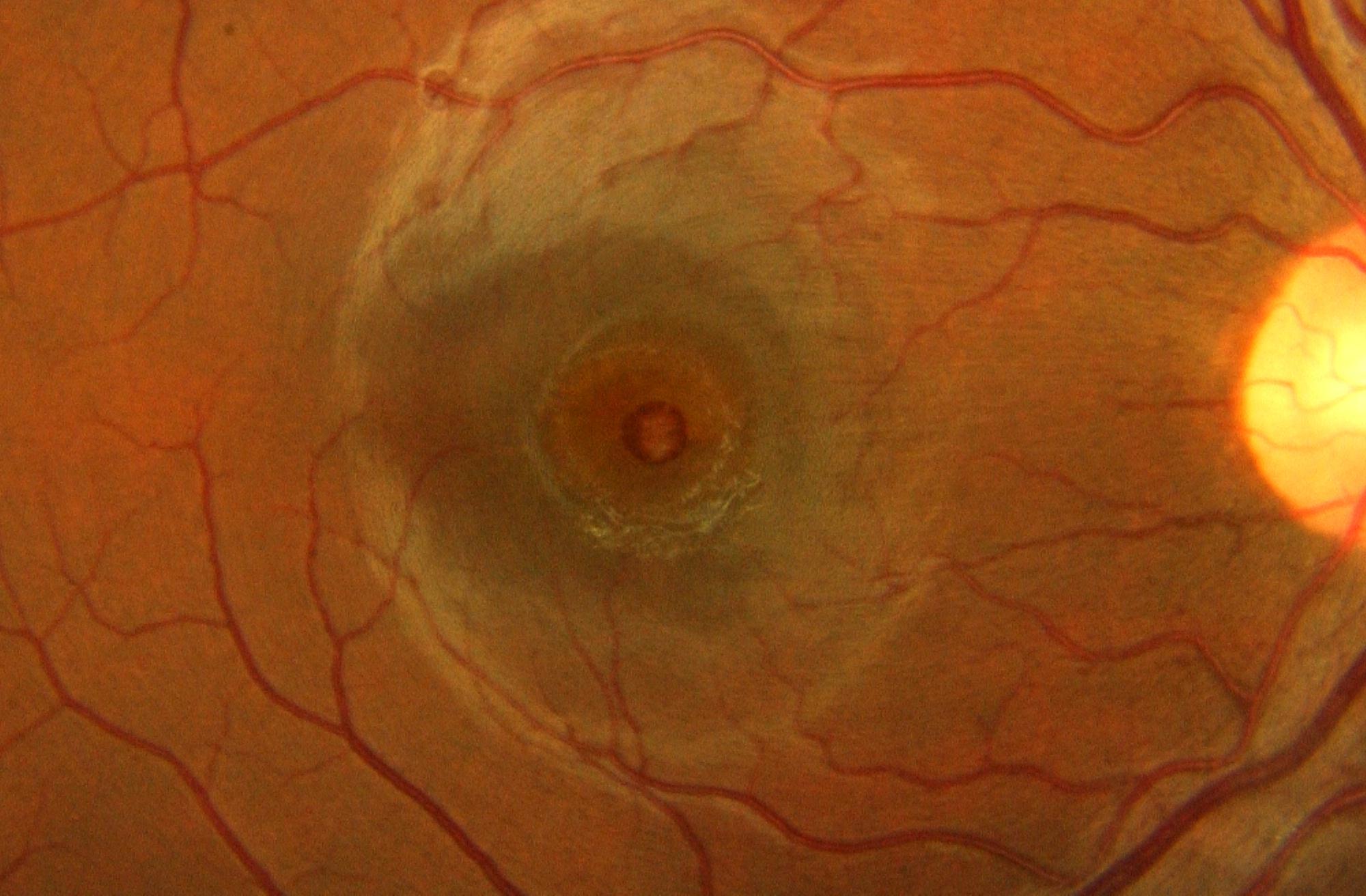 Imagen de un agujero macular