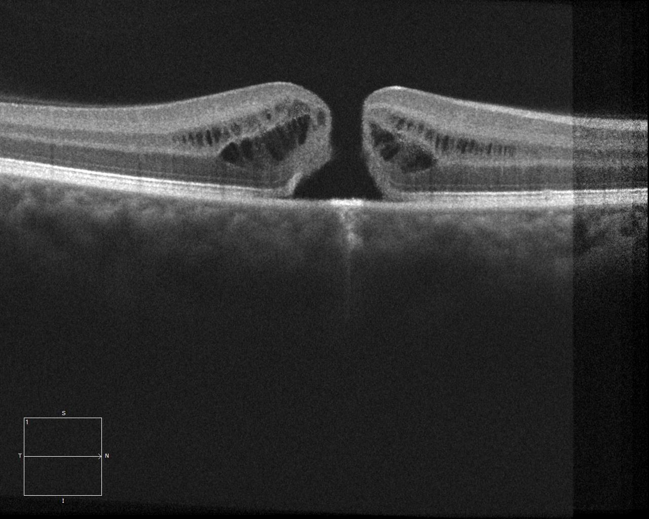 OCT de un agujero macular