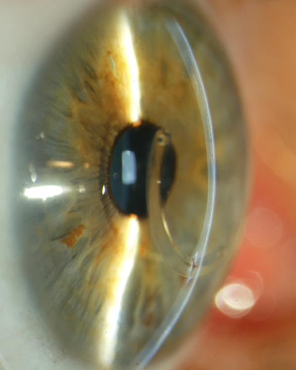 Aspecto de un ojo con queratocono al que se le ha implantado un segmento de anillo intracorneal