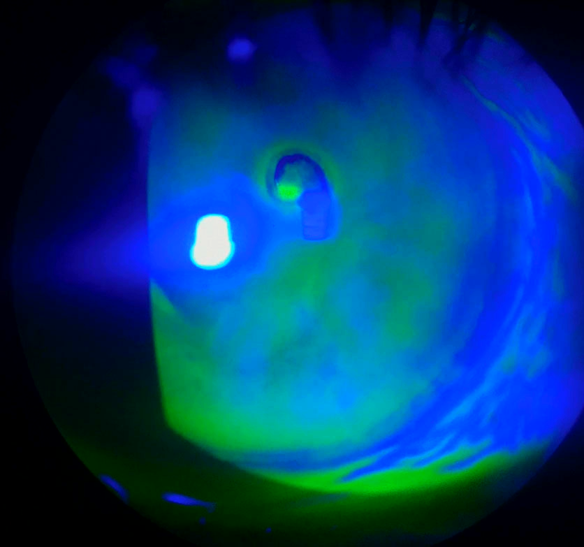 Aspecto de un paciente con erosión corneal recurrente