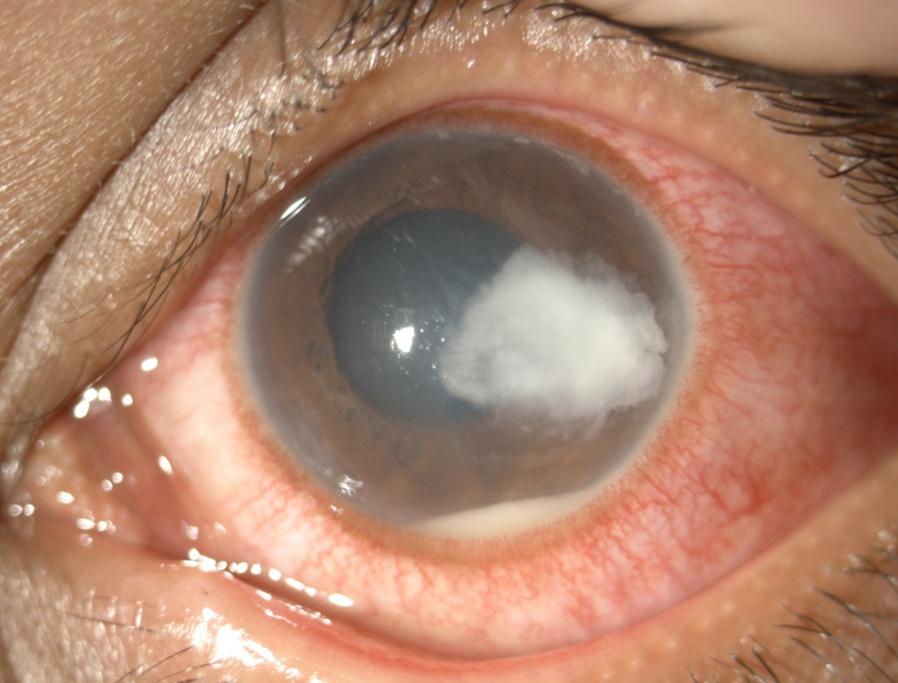 Queratitis infecciosa de origen fúngica.