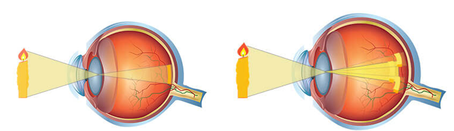 Comparativa entre un ojo normal (izquierda) donde la imagen cae sobre la retina y uno con astigmatismo (derecha) donde se observa que hay dos puntos de enfoque distintos.