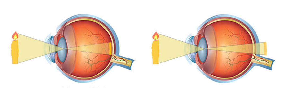 la izquierda un ojo sin defecto de refracción en el que la imagen se proyecta en la retina y a la derecha un ojo hipermetrope donde la imagen se proyecta por detras de la retina.