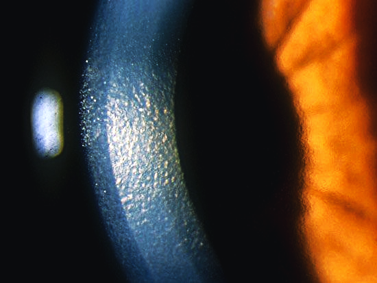 magen de lámpara de hendidura de una córnea con distrofia endotelial de Fuchs