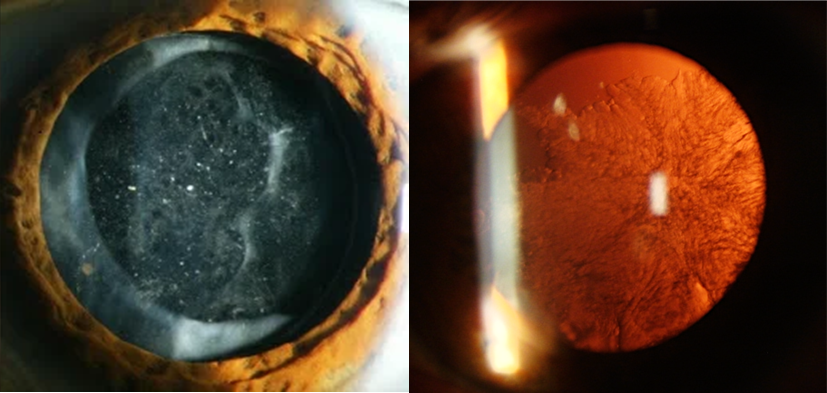 Dos casos de opacidad de la cápsula posterior (visión con luz directa a la izquierda y con retroiluminación a la derecha)