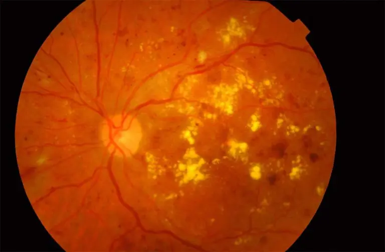 Forma de presentación de un paciente diabético con retinopatía diabética grave. Observe las hemorragias y los exudados (manchas amarillas).