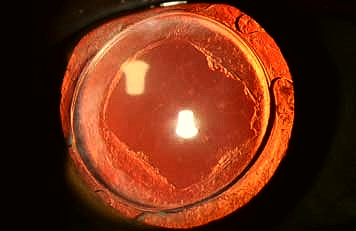 Imagen de un ojo tras la realización de láser YAG. Se aprecia un ojal central en forma de diamante por donde podrá volver a entrar la luz de manera correcta. 