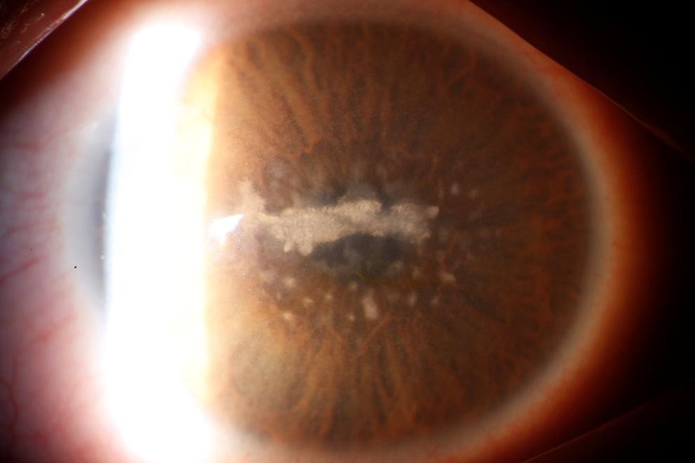 Paciente con una distrofia corneal que le produce leucomas centrales que afectan a la visión.