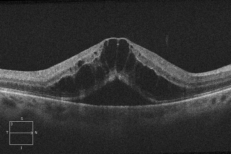 Edema macular producido por una oclusión venosa