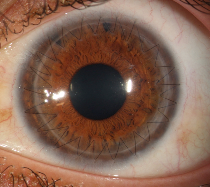 Paciente al que se le tuvo que realizar un trasplante penetrante de gran tamaño debido a una queratitis infecciosa agresiva.