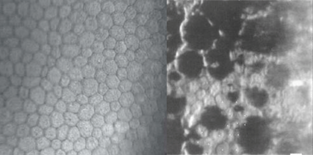 Imagen de microscopia especular en el que se aprecia un endotelio sano a la izquierda y uno afecto de distrofia endotelial de Fuchs a la derecha.