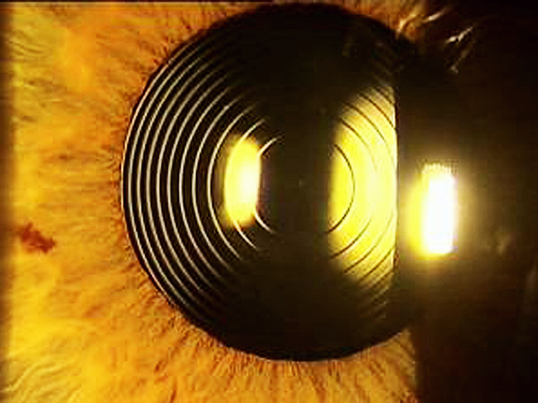 Imagen de una lente multifocal implantada