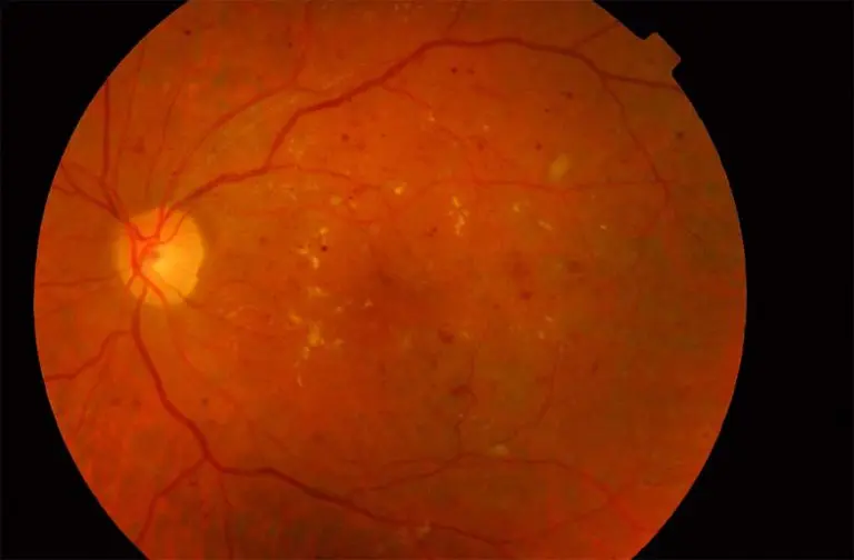 Aspecto del paciente anterior tras un tratamiento combinado de láser e inyecciones intraoculares.