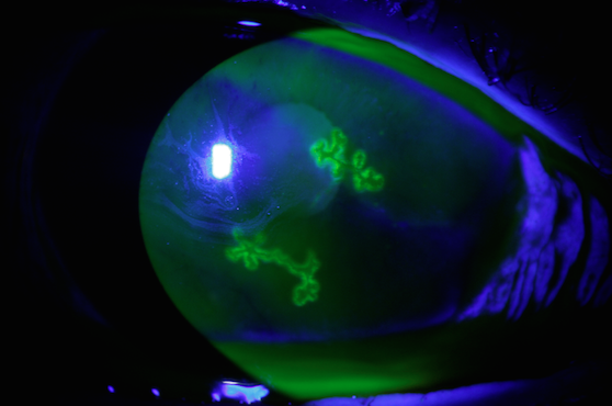 Queratitis producida por el virus del herpes