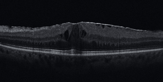 Membrana epirretiniana