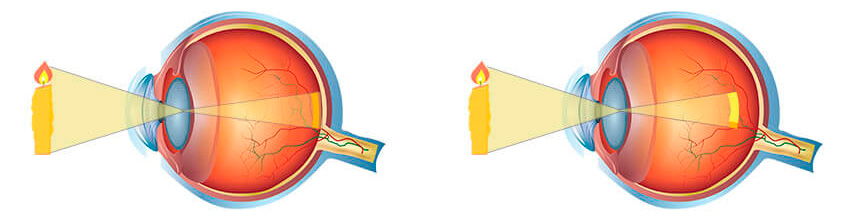 A la izquierda imagen de un ojo sin defecto de graduación donde la imagen se proyecta sobre la retina y a la derecha un paciente con miopía donde la imagen se proyecta por delante de la retina.