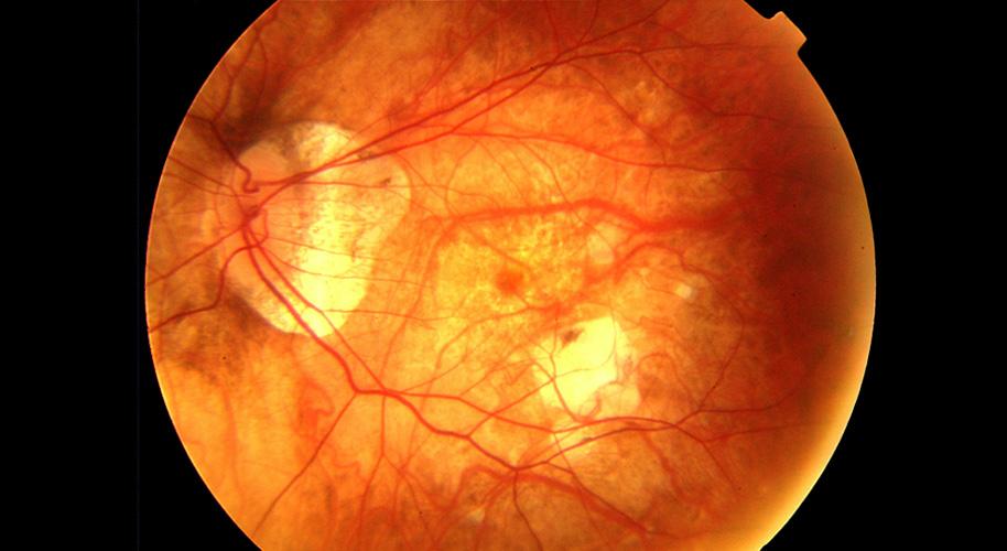  Imagen de una retina con signos claros de miopía magna