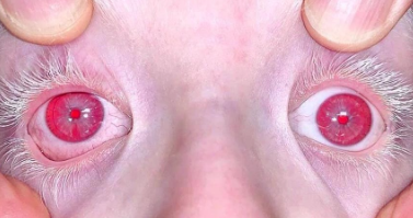 Paciente con albinismo y nistagmus